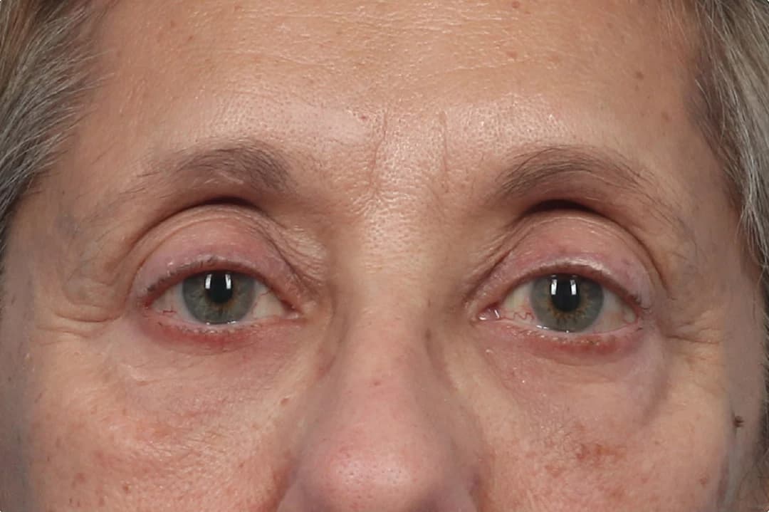 EMFACE Eyes, under-eye area and lids, after