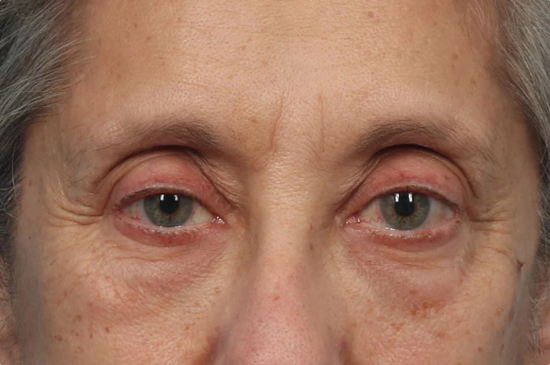 EMFACE Eyes, under-eye area and lids, before