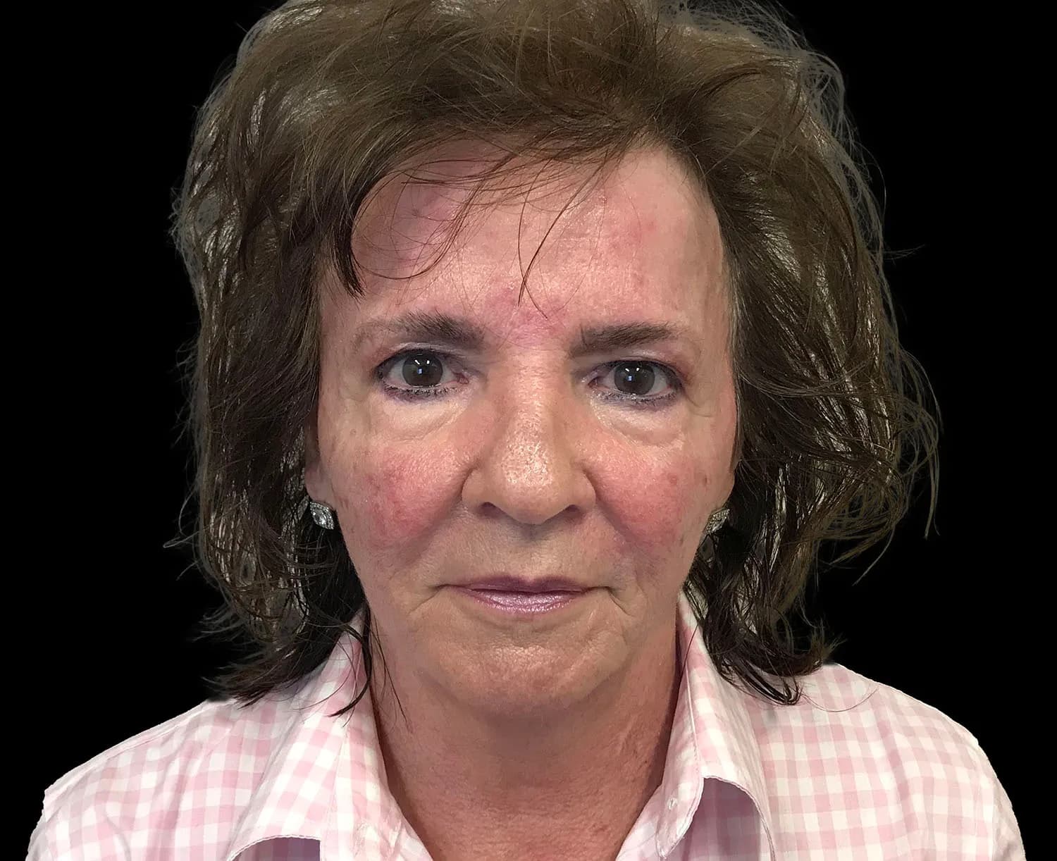 EMFACE, full face, front view, after