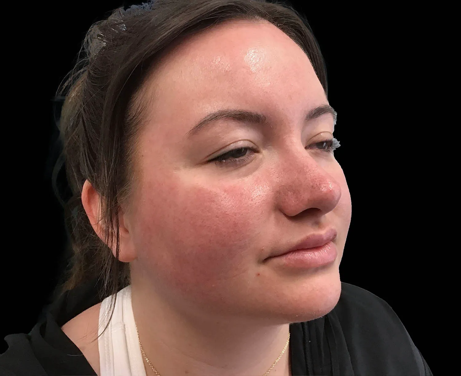 EMFACE, cheeks and jawline, oblique view, after