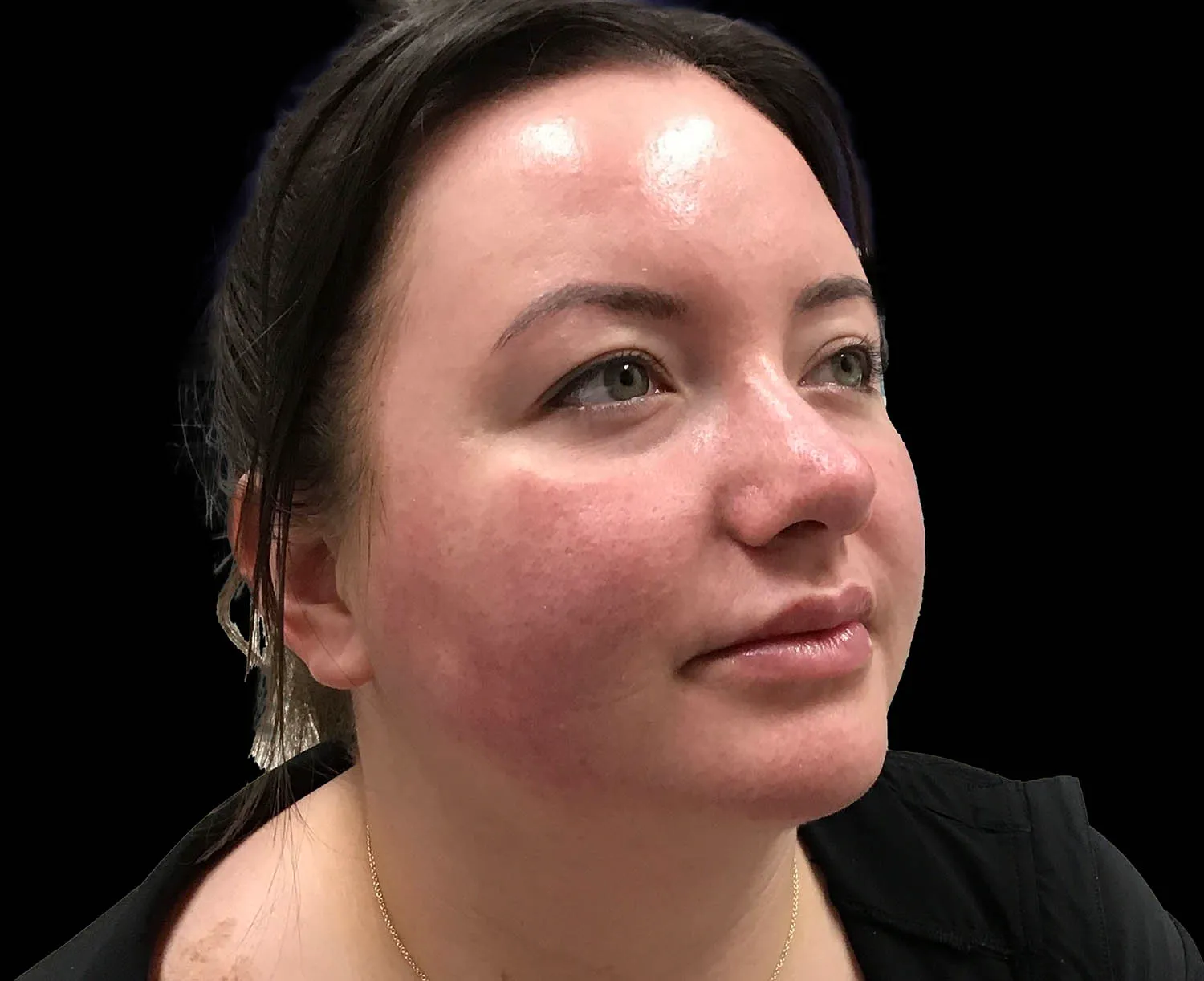 EMFACE, cheeks and jawline, oblique view, before