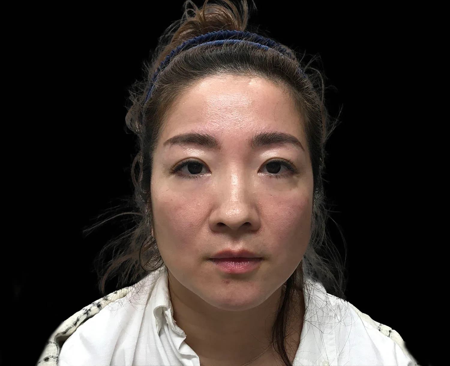 EMFACE, full face, front view, after
