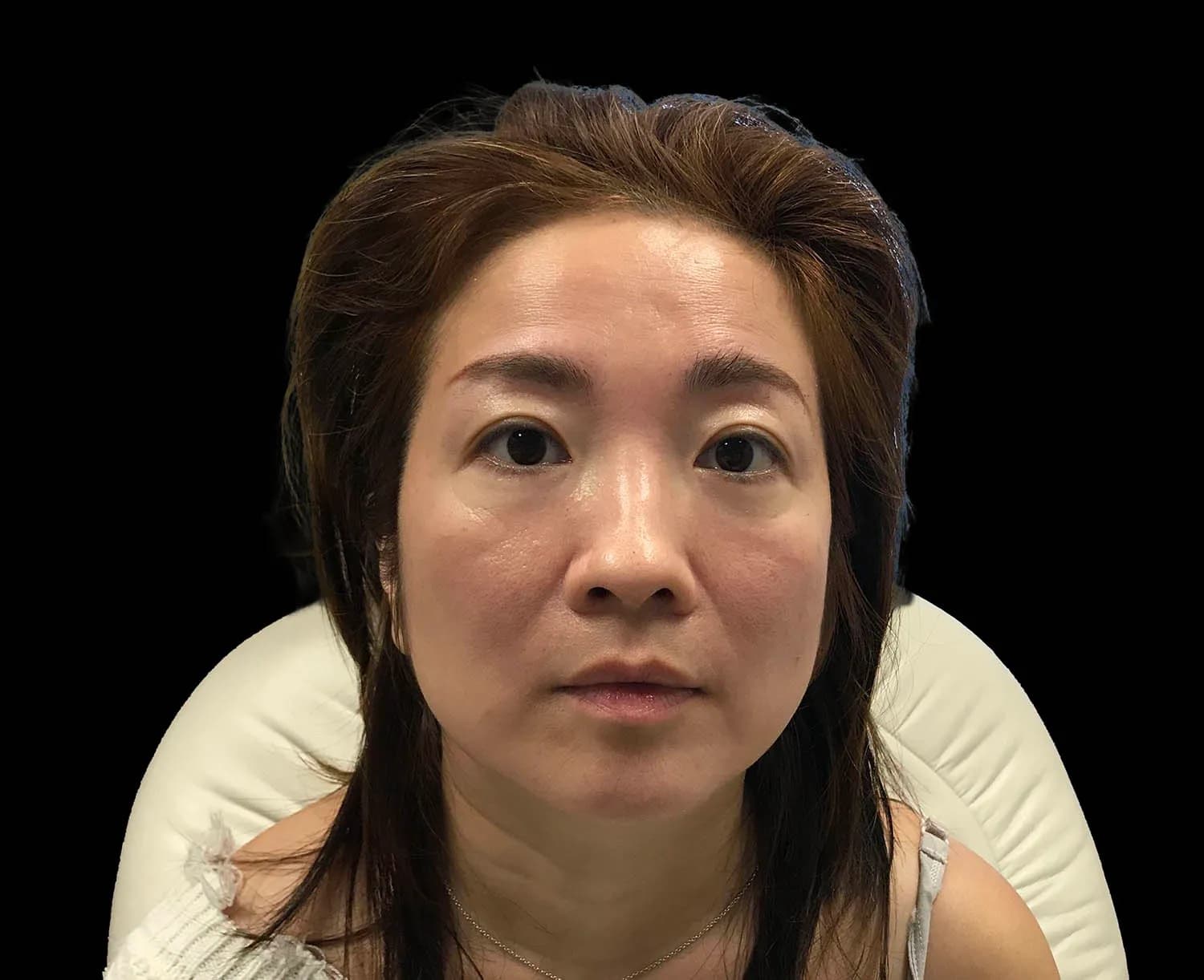 EMFACE, full face, front view, before