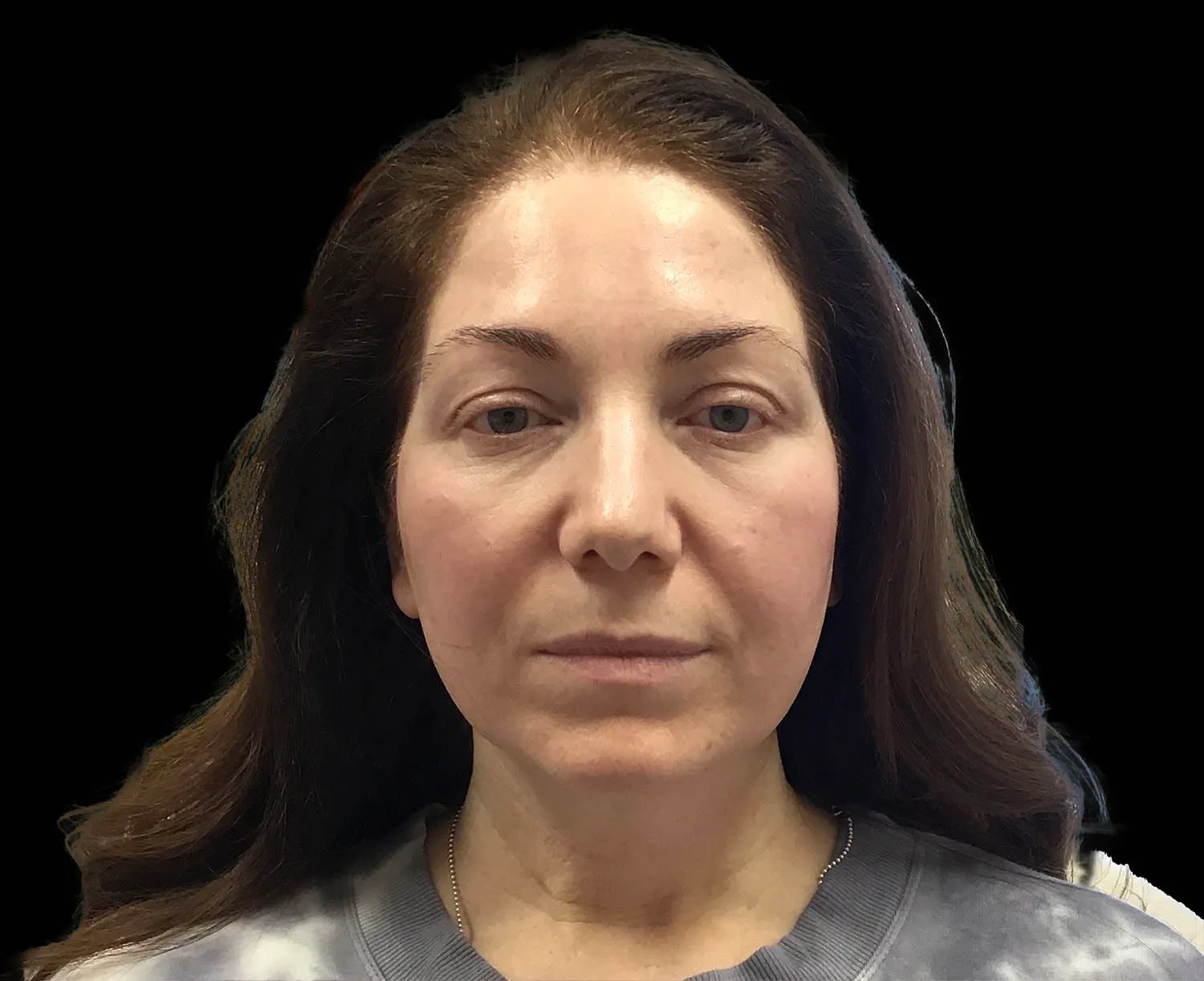 EMFACE, full face, front view, after
