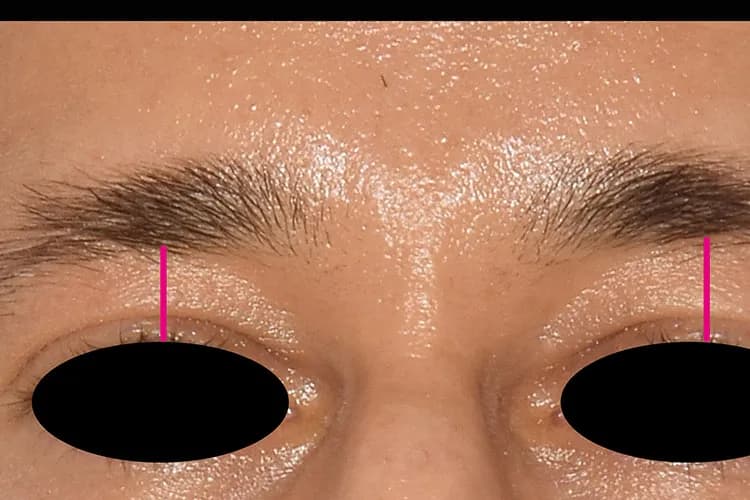 EMFACE, brow lift, three months after the fourth treatment, after
