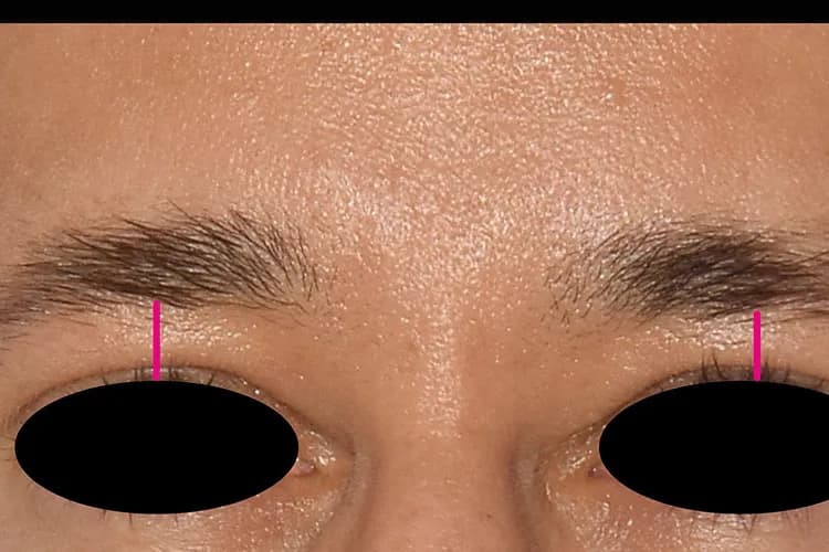 EMFACE, brow lift, three months after the fourth treatment, before