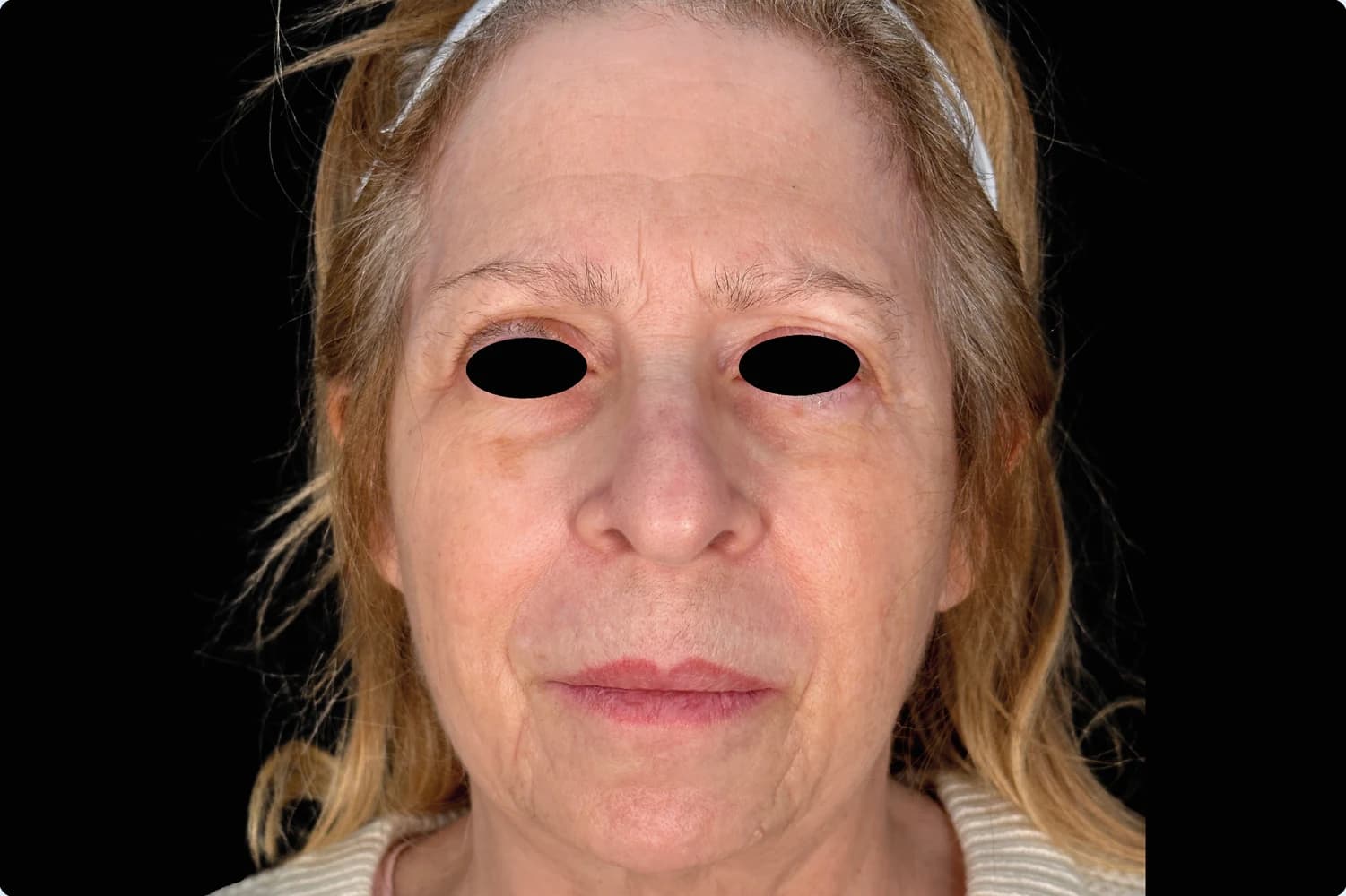 EMFACE, full face, front view, after