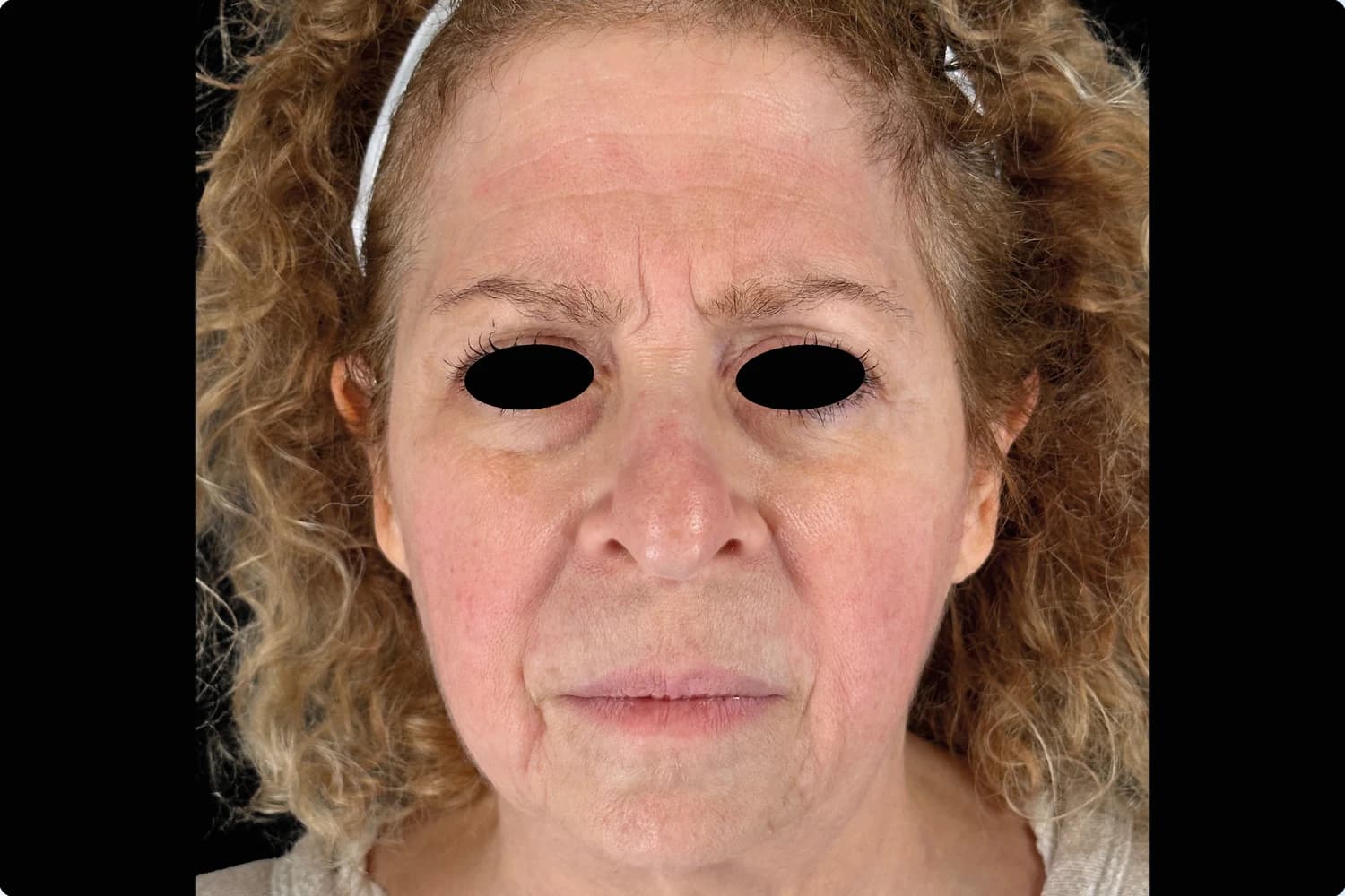 EMFACE, full face, front view, before