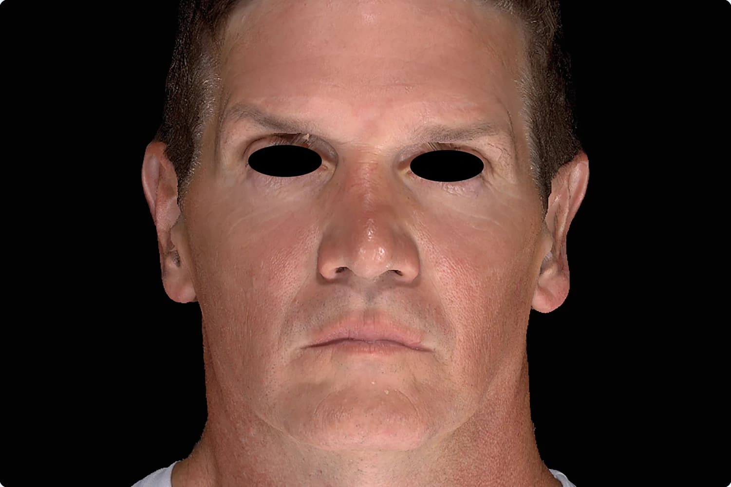 EMFACE, full face, front view, after