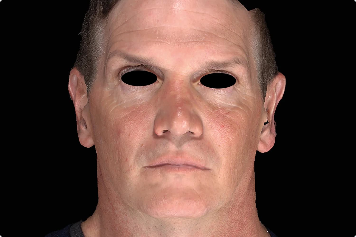 EMFACE, full face, front view, before