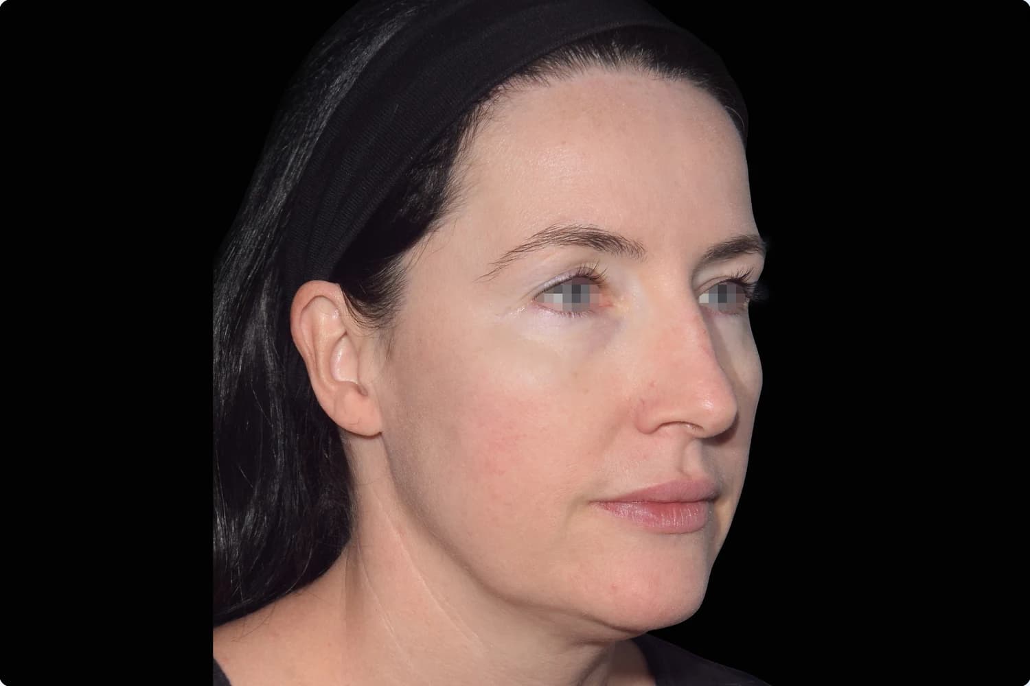 EMFACE, cheeks and jawline, before