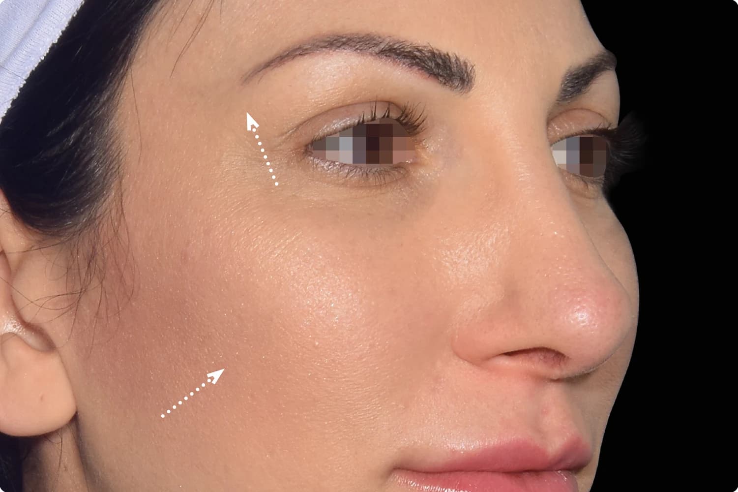 EMFACE, cheeks and midface, after
