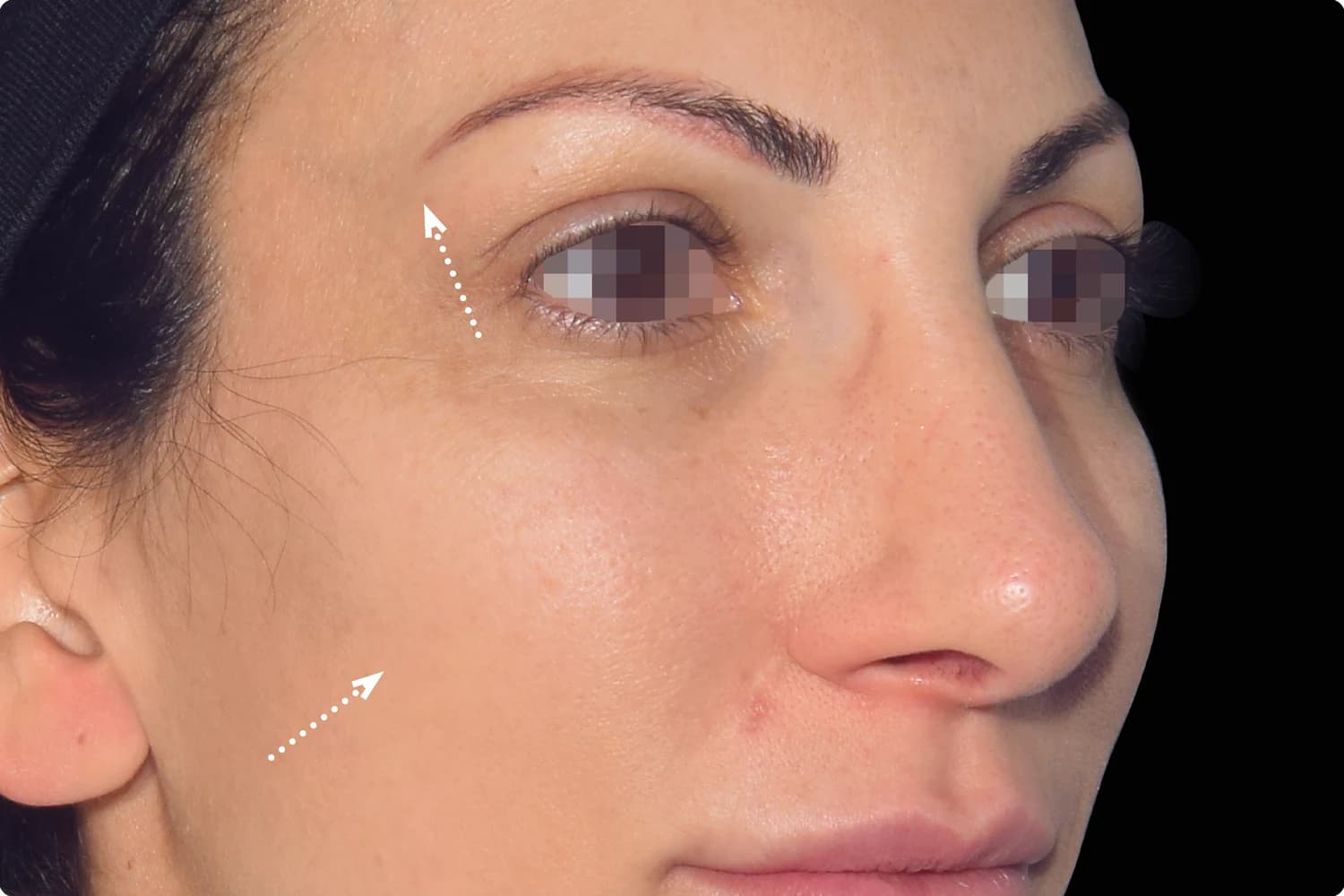 EMFACE, cheeks and midface, before