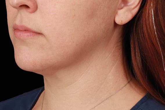 EMFACE Submentum, jawline and neck, after
