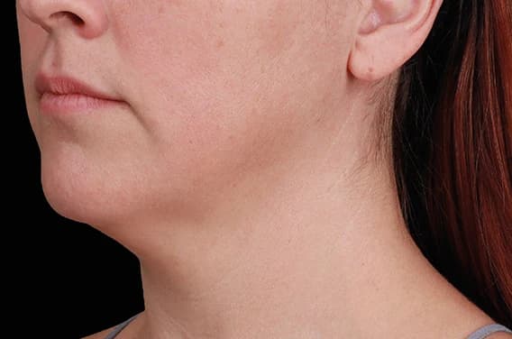 EMFACE Submentum, jawline and neck, before