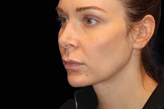 EMFACE Submentum, chin and jawline, oblique view, after