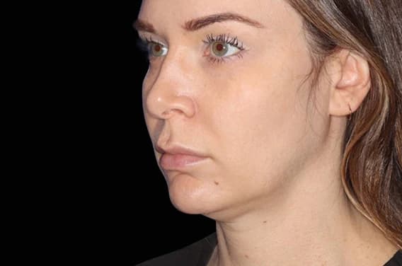 EMFACE Submentum, chin and jawline, oblique view, before