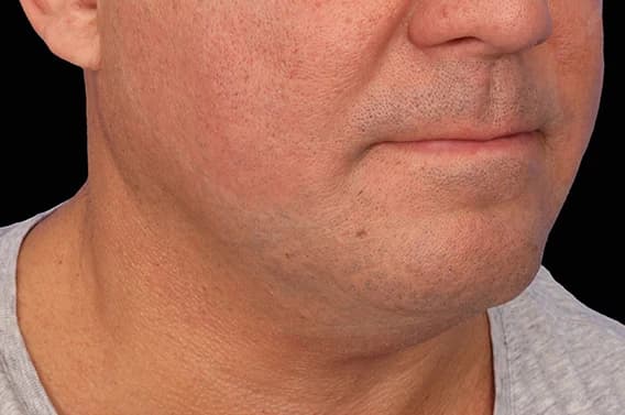 EMFACE Submentum, double chin, after
