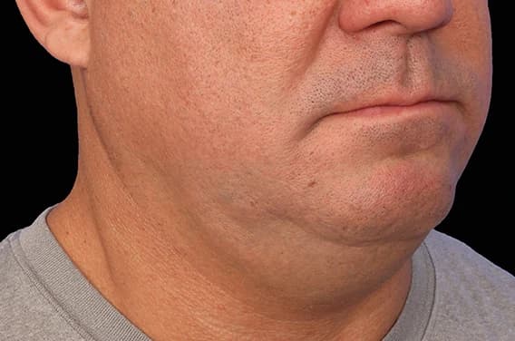 EMFACE Submentum, double chin, before