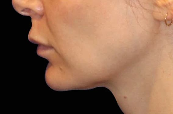 EMFACE Submentum, chin profile, after