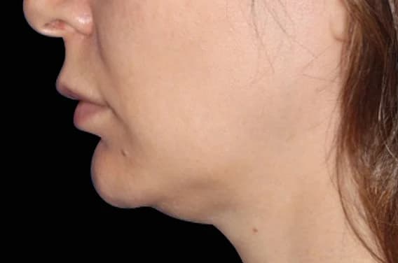 EMFACE Submentum, chin profile, before