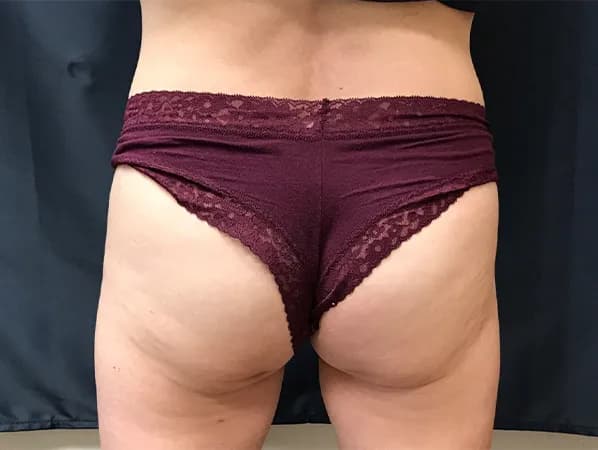 Emsculpt NEO, buttocks, after