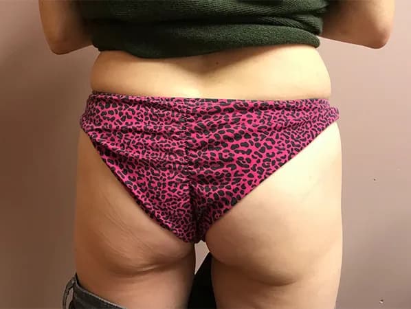 Emsculpt NEO, buttocks, before