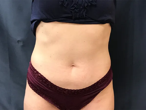 Emsculpt NEO, abdomen, after