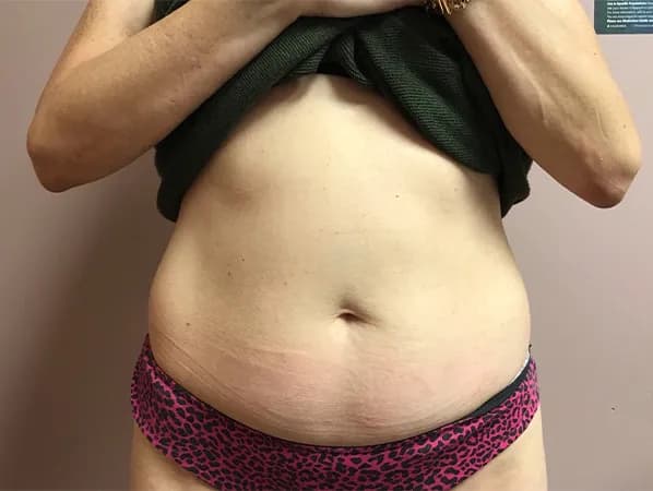 Emsculpt NEO, abdomen, before