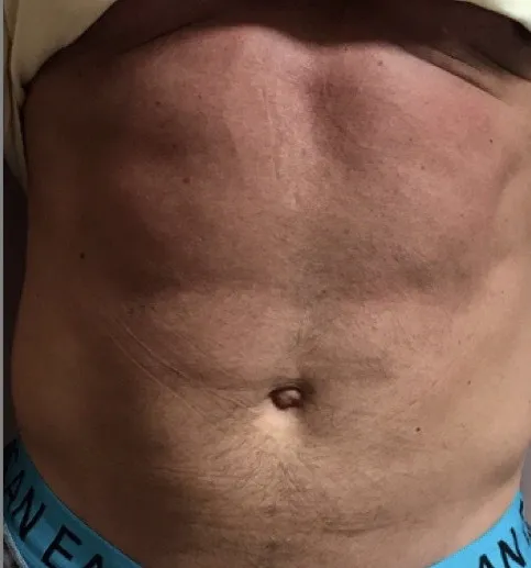 Emsculpt NEO, abdomen, after