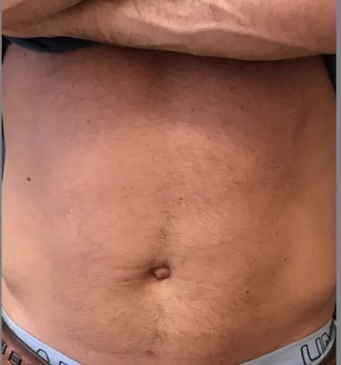 Emsculpt NEO, abdomen, before