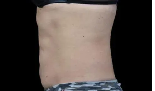 Emsculpt, abdomen, side view, eight weeks after the fourth treatment, after