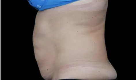 Emsculpt, abdomen, side view, eight weeks after the fourth treatment, before