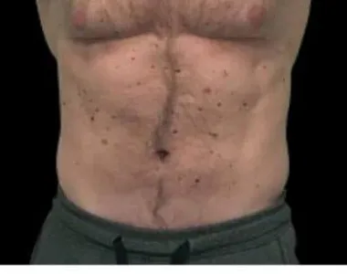 Emsculpt, abdomen, after the fourth treatment, after