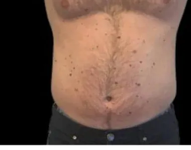 Emsculpt, abdomen, after the fourth treatment, before
