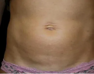 Emsculpt, abdomen, after the fourth treatment, after