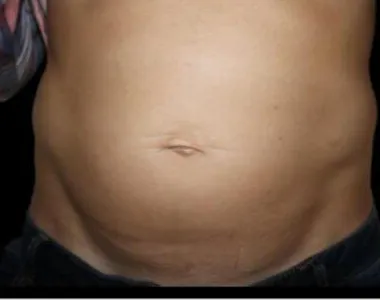 Emsculpt, abdomen, after the fourth treatment, before