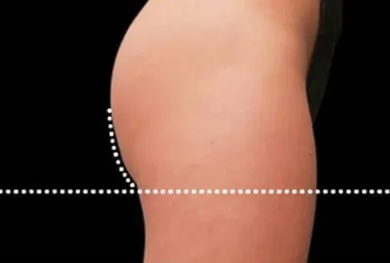 Emsculpt, buttock lift, after the fourth treatment, after