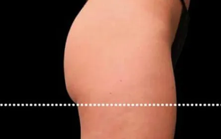 Emsculpt, buttock lift, after the fourth treatment, before