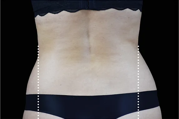 Emsculpt NEO, abdomen and waist, after