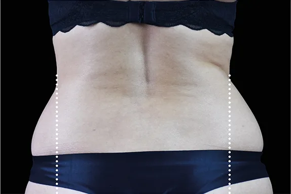 Emsculpt NEO, abdomen and waist, before