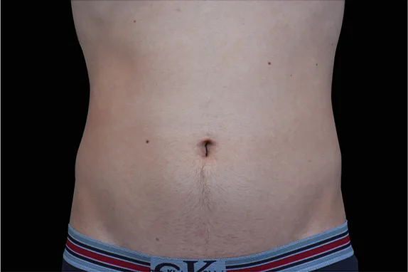 Emsculpt NEO, abdomen, before