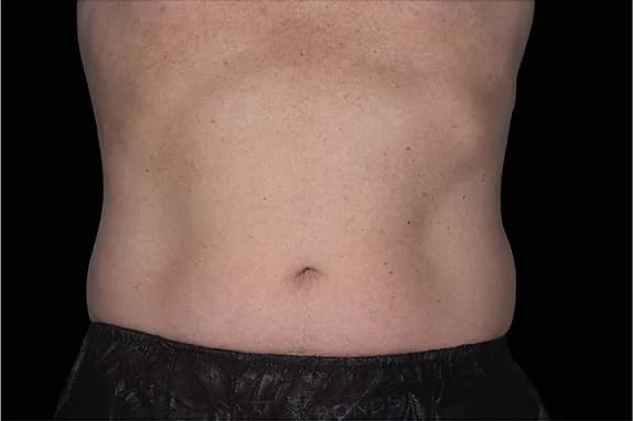 Emsculpt NEO, abdomen, after