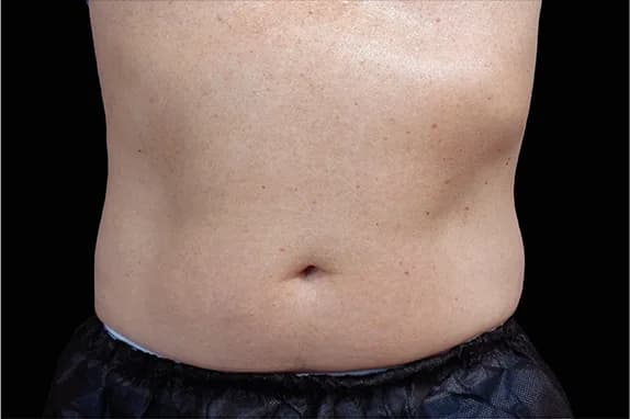 Emsculpt NEO, abdomen, before