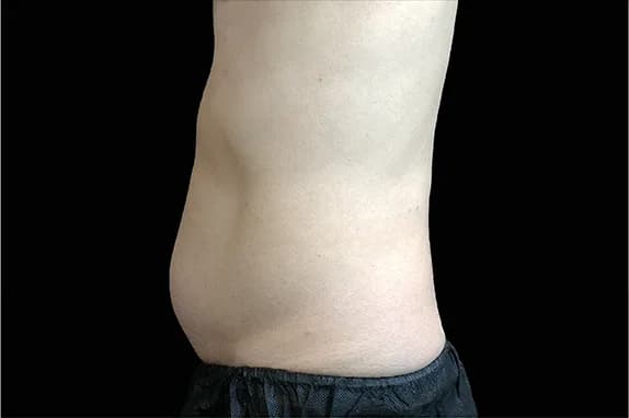 Emsculpt NEO, abdomen, side view, after