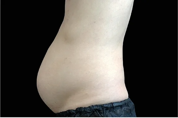 Emsculpt NEO, abdomen, side view, before