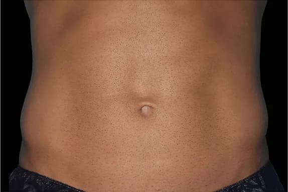 Emsculpt NEO, abdomen, after