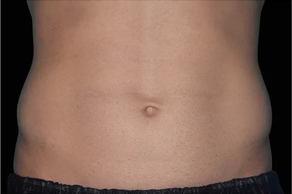 Emsculpt NEO, abdomen, before