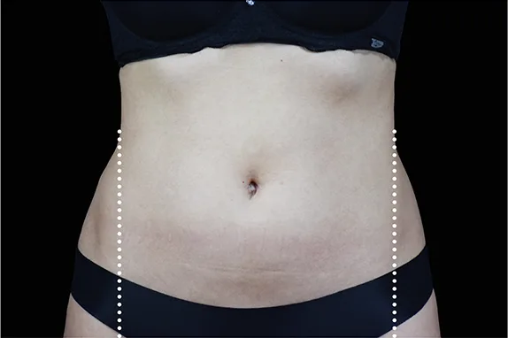 Emsculpt NEO, flanks and lower back, after