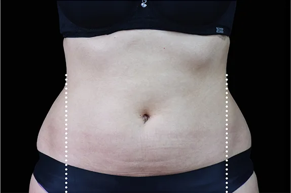 Emsculpt NEO, flanks and lower back, before